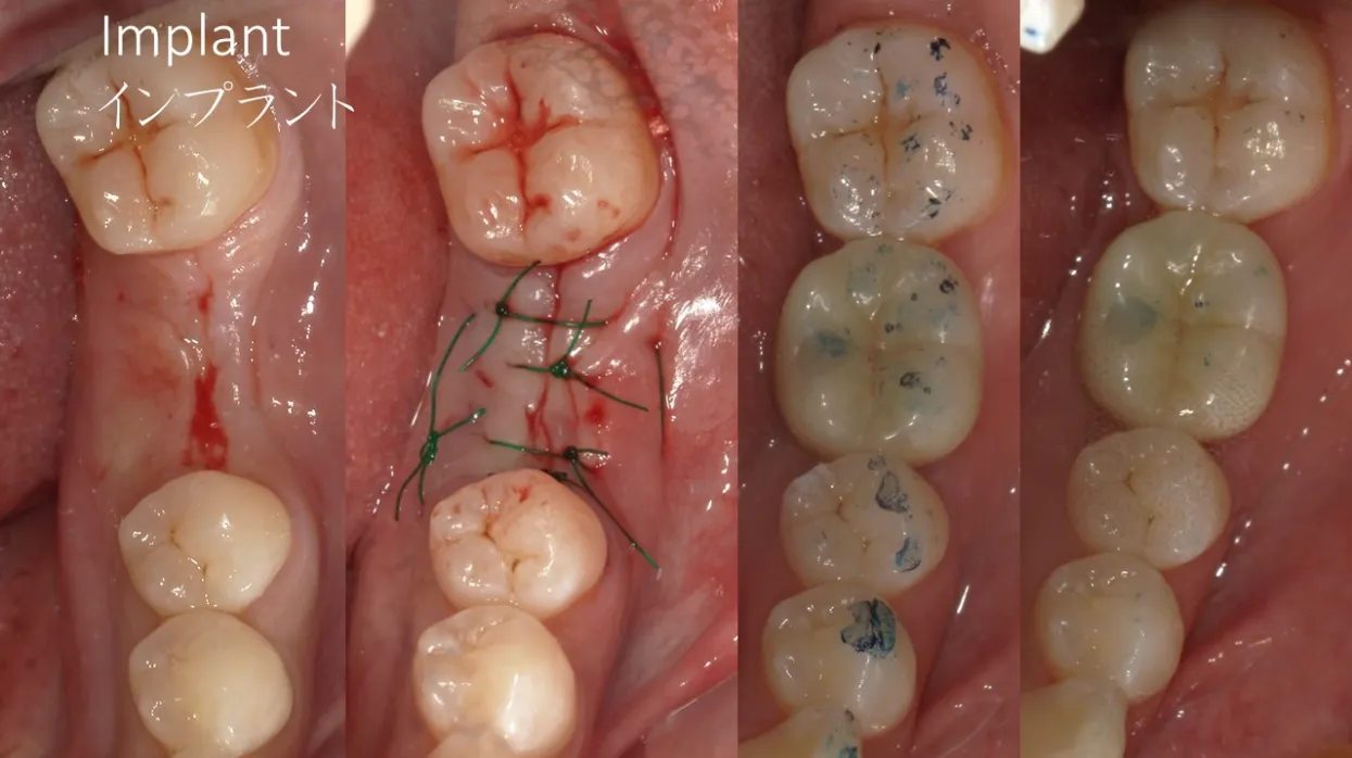 インプラント治療の事例紹介